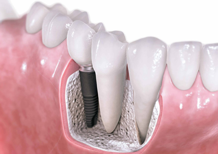 Dental Implants in Vancouver WA