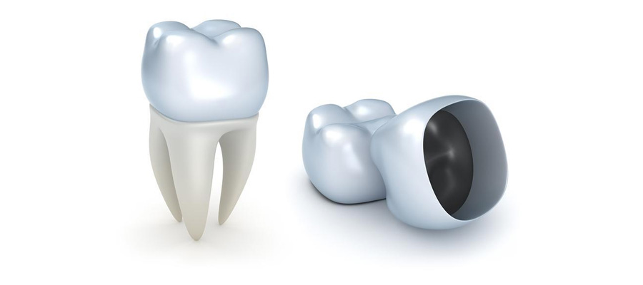 Dental Crowns in Vancouver WA