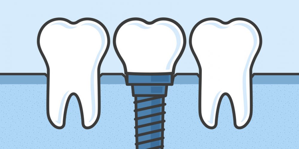 Benefits of Dental Implants in Vancouver WA