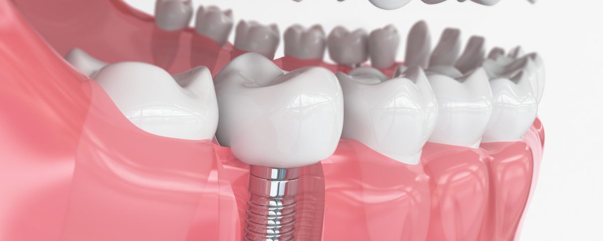 Types of Dental Implants in Vancouver WA