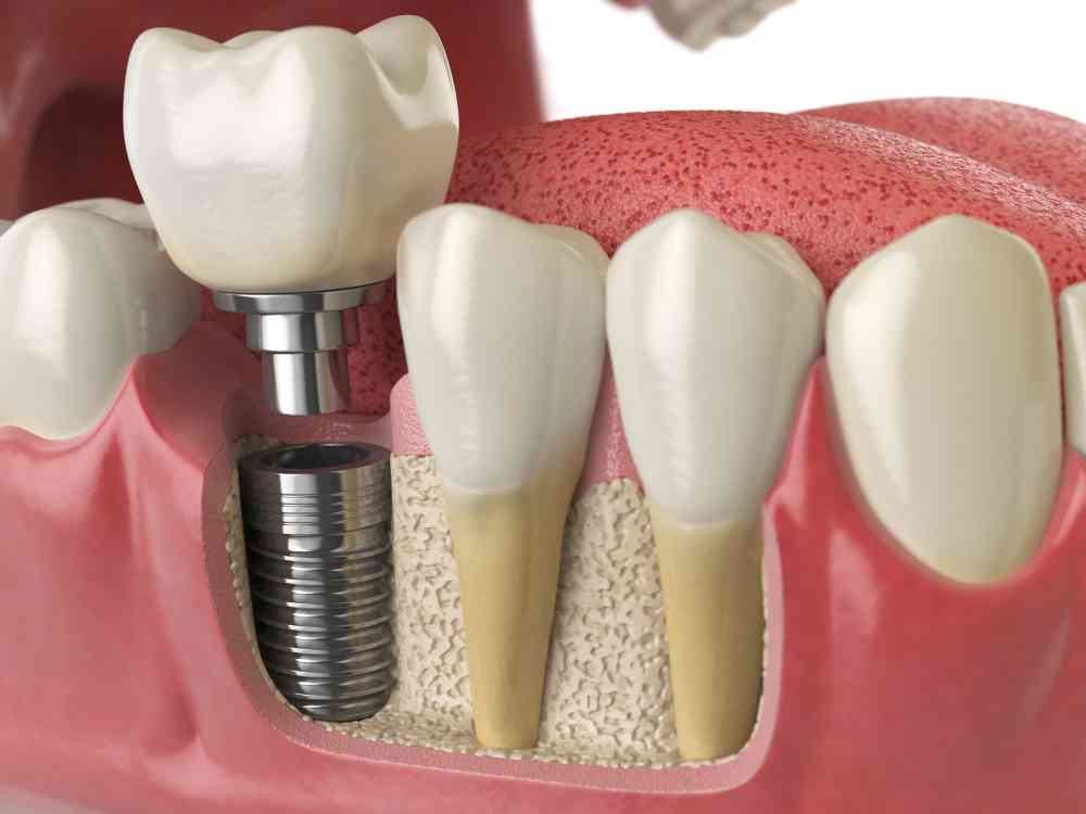Caring for Dental Implants in Vancouver WA