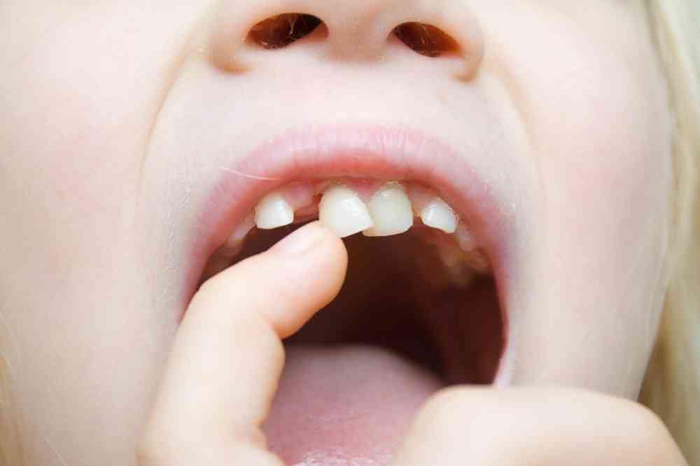 Baby Teeth Extraction in Vancouver WA