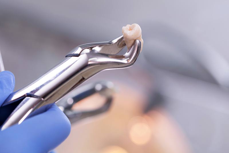 Tooth Extraction in Vancouver WA