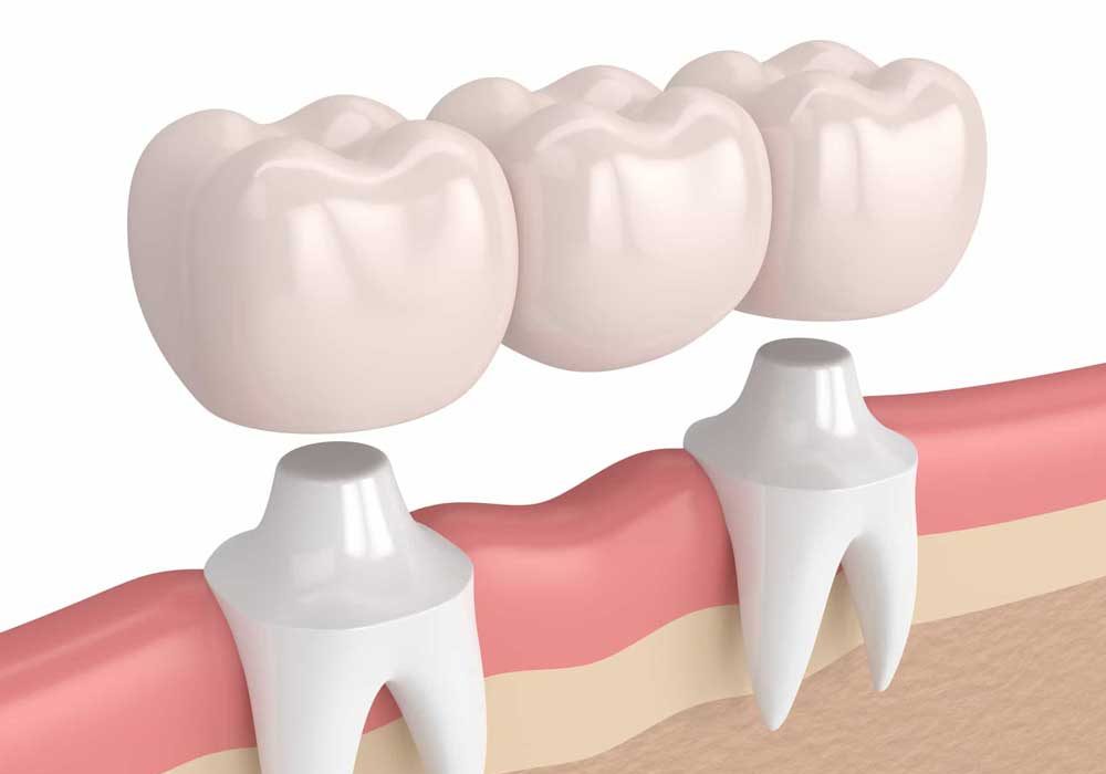 Dental Bridges in Vancouver WA