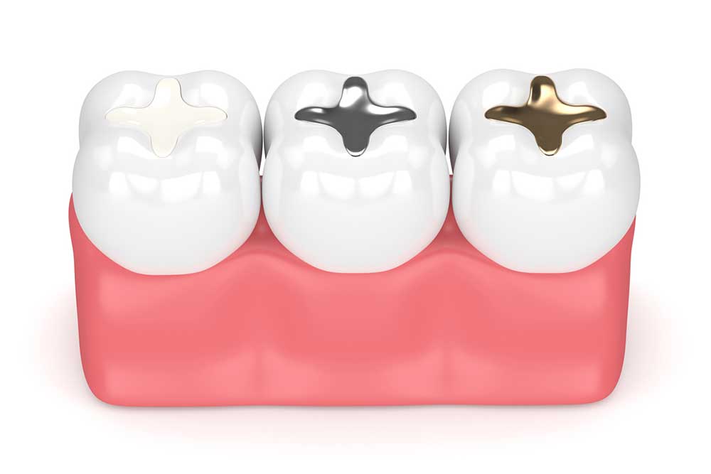 Dental Fillings for Cavities in Vancouver, WA