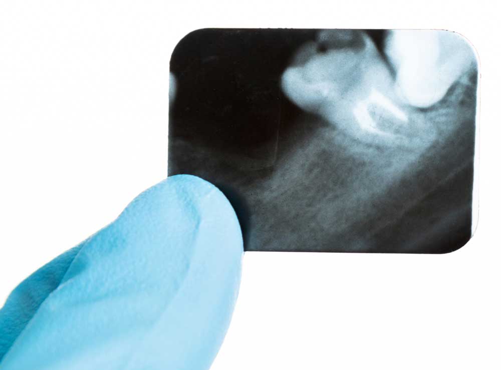 Root Canals in Vancouver WA