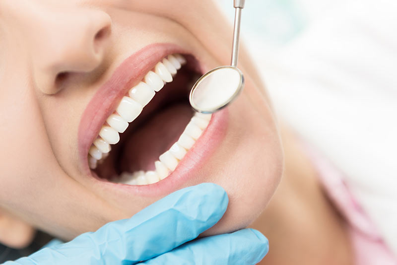 Dental Fillings for Cavities